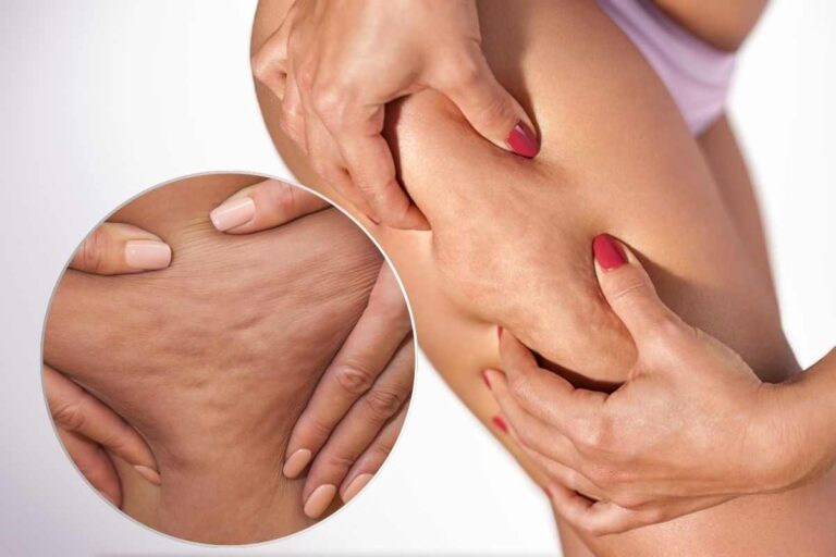 cellulite gambe glutei come combatterla